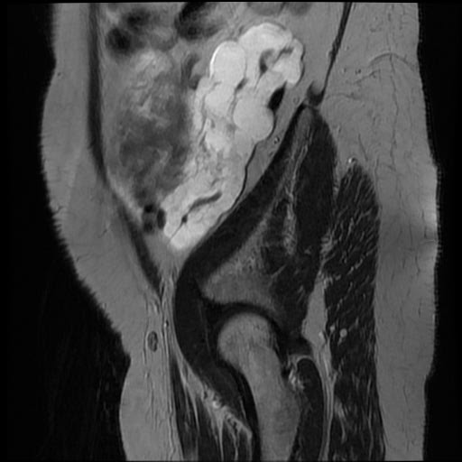 File:Atypical retroperitoneal lymphocoeles with large leiomyoma of uterus (Radiopaedia 32084-33027 Sagittal T2 2).jpg