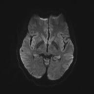 Autoimmune limbic encephalitis (Radiopaedia 30363-31005 Axial B0 and DWI 47).jpg