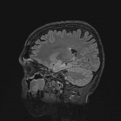 File:Autoimmune limbic encephalitis (Radiopaedia 30363-31005 Sagittal FLAIR 100).jpg
