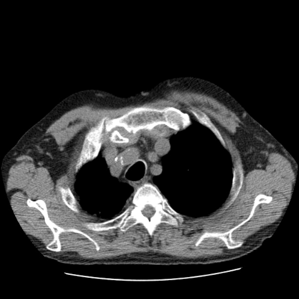 Autosomal dominant polycystic kidney disease (Radiopaedia 27851-28094 Axial non-contrast 9).jpg