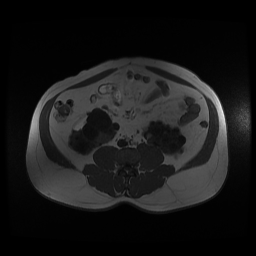Autosomal dominant polycystic kidney disease (Radiopaedia 50259-55611 Axial 2D Dual Echo 64).jpg