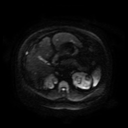 Autosomal dominant polycystic kidney disease (Radiopaedia 50259-55611 Axial DWI 88).jpg
