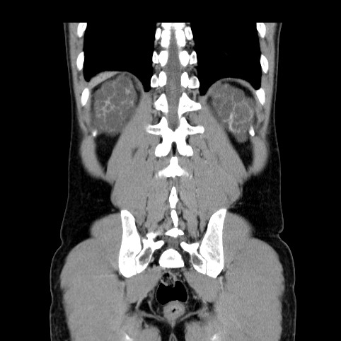 File:Autosomal dominant polycystic kidney disease (Radiopaedia 66349-75582 A 76).jpg