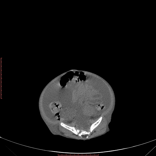 File:Autosomal recessive polycystic kidney disease associated with Caroli disease (Radiopaedia 61932-69984 Axial non-contrast 295).jpg