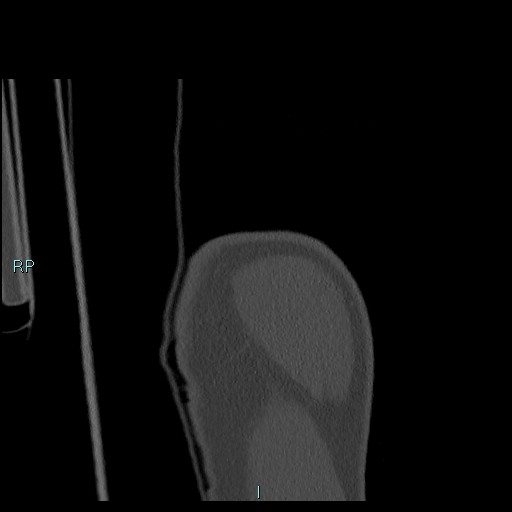 Avascular necrosis after fracture dislocations of the proximal humerus (Radiopaedia 88078-104655 Coronal bone window 18).jpg