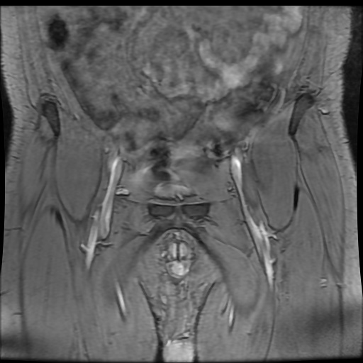 Avascular necrosis of the hip (Radiopaedia 61503-69465 F 6).jpg