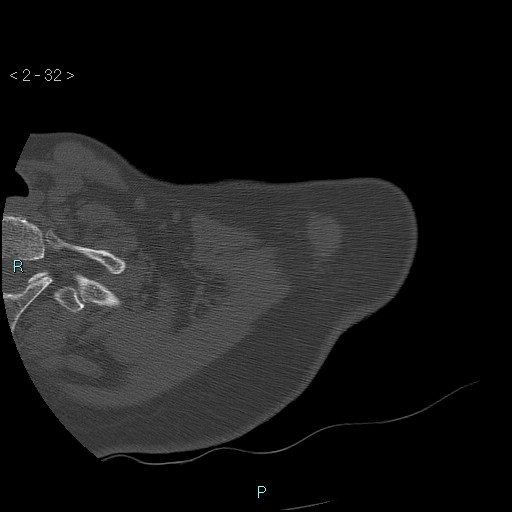 File:Avascular necrosis of the shoulder - Cruess stage I (Radiopaedia 77674-89887 Axial bone window 8).jpg