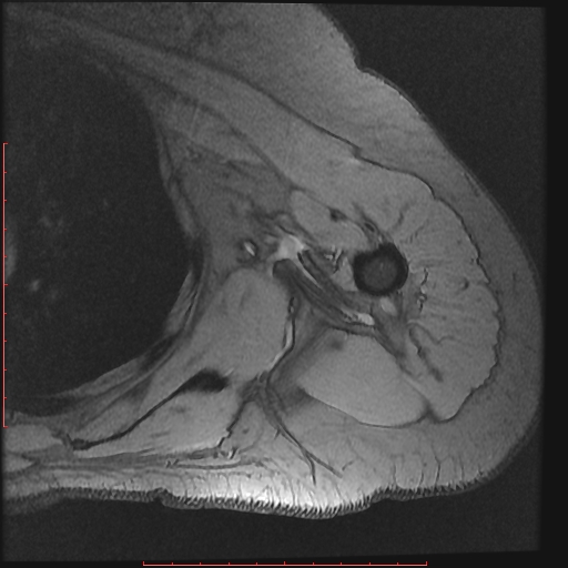 File:Avulsion fracture - greater tuberosity of humerus (Radiopaedia 25457-25703 Axial Gradient Echo 18).jpg