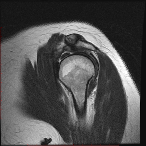 File:Avulsion fracture - greater tuberosity of humerus (Radiopaedia 25457-25703 Sagittal T2 7).jpg