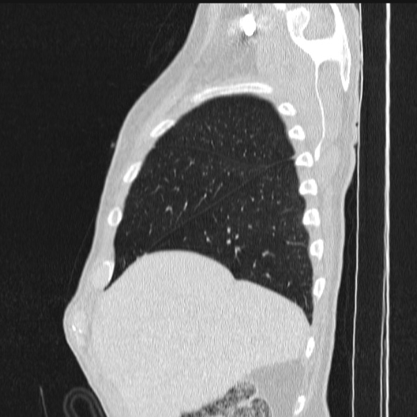 Azygos lobe (Radiopaedia 38259-40275 lung window 18).jpg