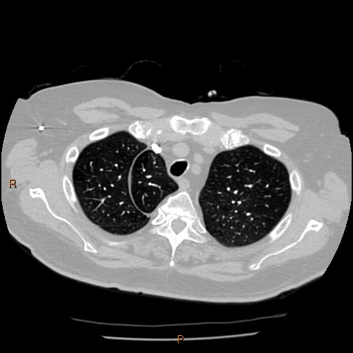 Azygos lobe (Radiopaedia 40161-42821 Axial lung window 7).jpg