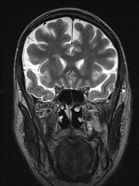 Balo concentric sclerosis (Radiopaedia 50458-55940 Coronal T2 18).jpg