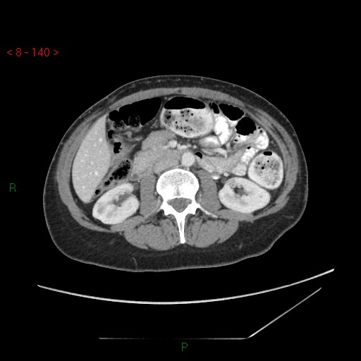 Bartholin gland cyst (Radiopaedia 54904-61181 A 35).jpg