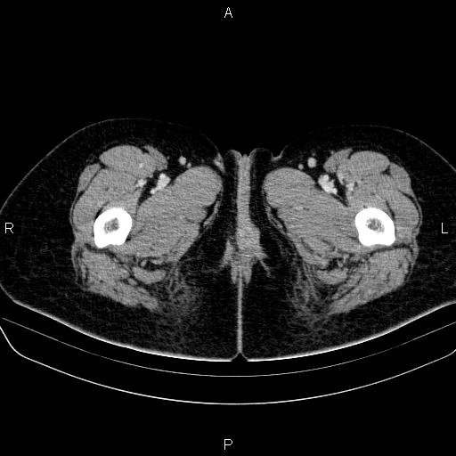 File:Bartholin gland cyst (Radiopaedia 62635-70930 Axial Post contrast 102).jpg