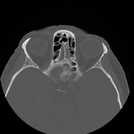 File:Base of skull chondrosarcoma (Radiopaedia 30410-31071 Axial bone window 30).jpg