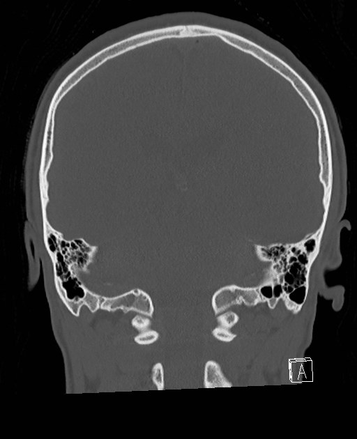 Base of skull fracture with bilateral Le Fort fractures (Radiopaedia 47094-51638 Coronal bone window 35).jpg