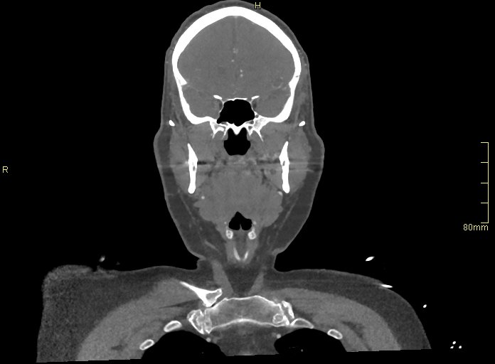 Basilar artery aneurysm (Radiopaedia 56261-62932 B 1).jpg