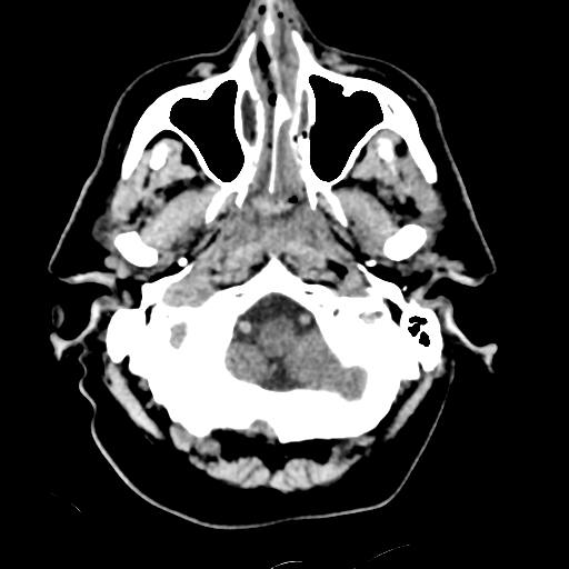 File:Basilar artery occlusion (Radiopaedia 33570-34659 Axial non-contrast 7).png