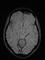 File:Basilar artery perforator aneurysm (Radiopaedia 82455-97733 Axial SWI 24).jpg
