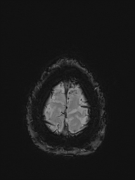 Basilar artery perforator aneurysm (Radiopaedia 82455-97733 Axial SWI 59).jpg