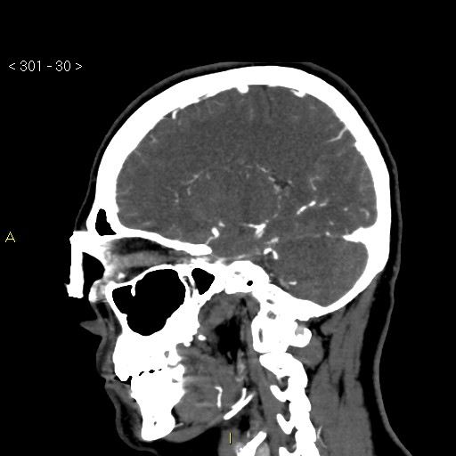 File:Basilar artery thrombosis (Radiopaedia 16260-15944 C 24).jpg