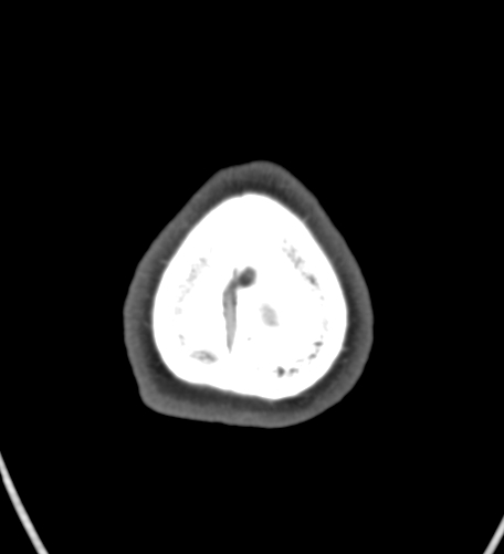 Basilar tip aneurysm with coiling (Radiopaedia 53912-60086 A 147).jpg