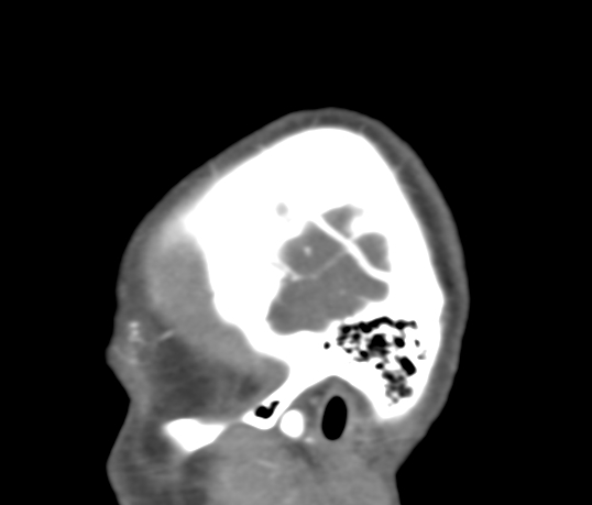 Basilar tip aneurysm with coiling (Radiopaedia 53912-60086 C 4).jpg