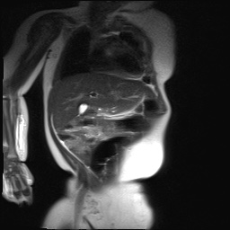 File:Beckwith-Wiedeman syndrome with bilateral Wilms tumors (Radiopaedia 60850-69233 B 20).jpg