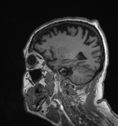 Behavioral variant frontotemporal dementia and late onset schizophrenia (Radiopaedia 52197-58083 Sagittal T1 75).png