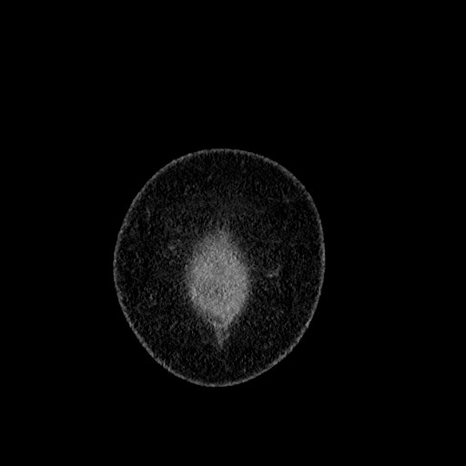 File:Benign leiomyoma with hydropic features (Radiopaedia 89250-106130 B 3).jpg