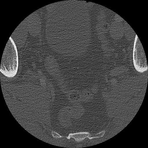 Benign post-traumatic pseudopneumoperitoneum (Radiopaedia 71199-81495 Axial bone window 311).jpg