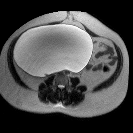 File:Benign seromucinous cystadenoma of the ovary (Radiopaedia 71065-81300 Axial T2 2).jpg