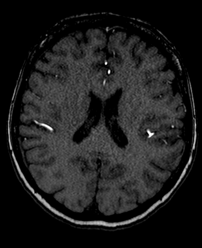 Berry aneurysm of the terminal internal carotid artery (Radiopaedia 88286-104918 Axial TOF 148).jpg