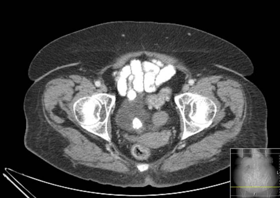 Bicameral celiacomesenteric aneurysm (Radiopaedia 55766-62327 A 67).jpg