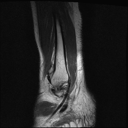 File:Bilateral Achilles tendon complete tear (Radiopaedia 81344-95051 Sagittal T2 29).jpg