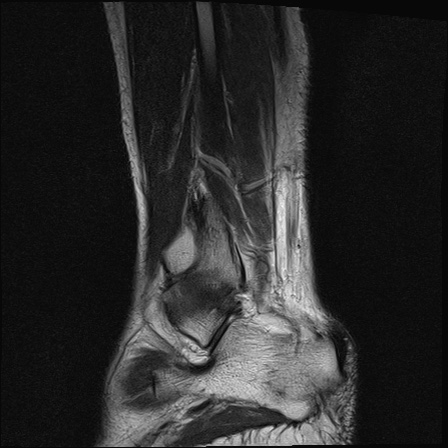 File:Bilateral Achilles tendon complete tear (Radiopaedia 81344-95051 Sagittal T2 4).jpg