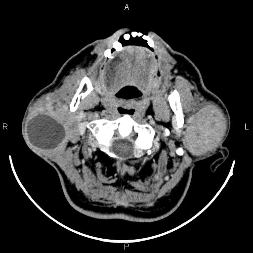 Bilateral Warthin tumors (Radiopaedia 84034-99263 Axial With contrast 20).jpg
