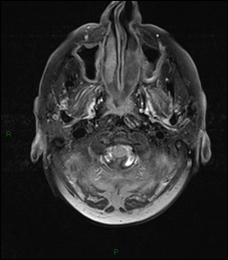 File:Bilateral acute middle cerebral artery territory infarcts (Radiopaedia 77319-89402 Axial FLAIR 2).jpg