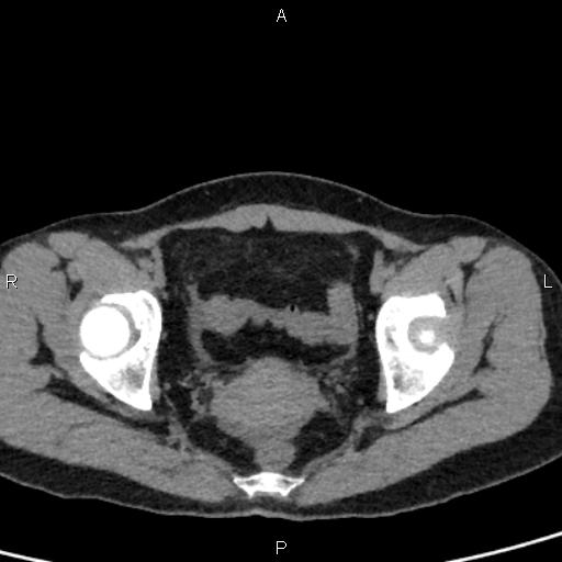 Bilateral adrenal gland hyperenhancement in pancreatitis (Radiopaedia 86642-102753 Axial non-contrast 101).jpg