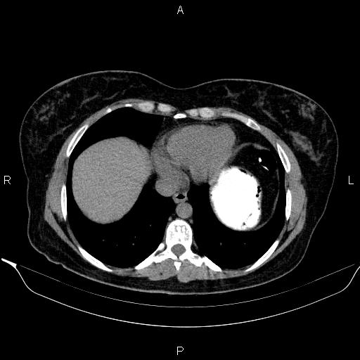 Bilateral adrenal myelolipoma (Radiopaedia 63058-71535 Axial non-contrast 9).jpg