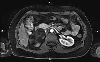 File:Bilateral adrenal myelolipoma (Radiopaedia 63058-71537 Axial T1 C+ fat sat 44).jpg