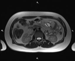 File:Bilateral adrenal myelolipoma (Radiopaedia 63058-71537 Axial T2 19).jpg