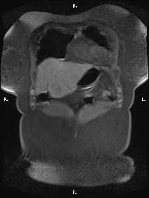 File:Bilateral adrenal myelolipoma (Radiopaedia 63058-71537 Coronal T1 fat sat 92).jpg