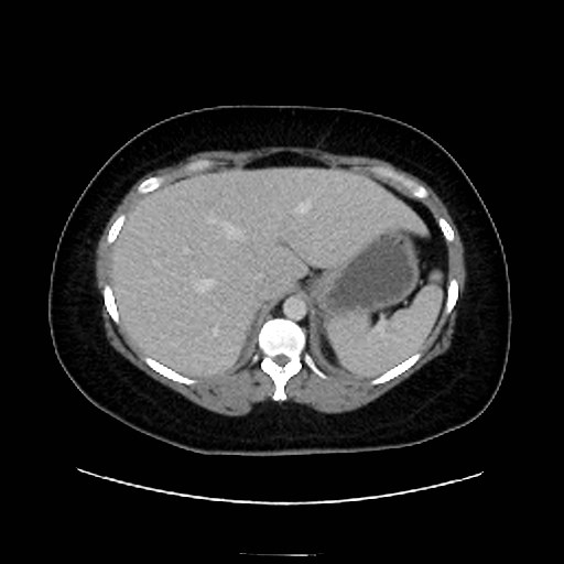 Bilateral adrenal thrombosis (Radiopaedia 58182-65256 A 12).jpg