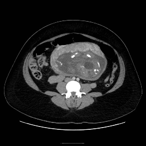 Bilateral adrenal thrombosis (Radiopaedia 58182-65256 A 43).jpg