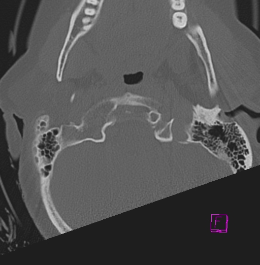 File:Bilateral atlanto-occipital assimilation (Radiopaedia 28350-28603 Axial bone window 4).jpg