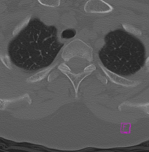 File:Bilateral atlanto-occipital assimilation (Radiopaedia 28350-28603 Axial bone window 49).jpg