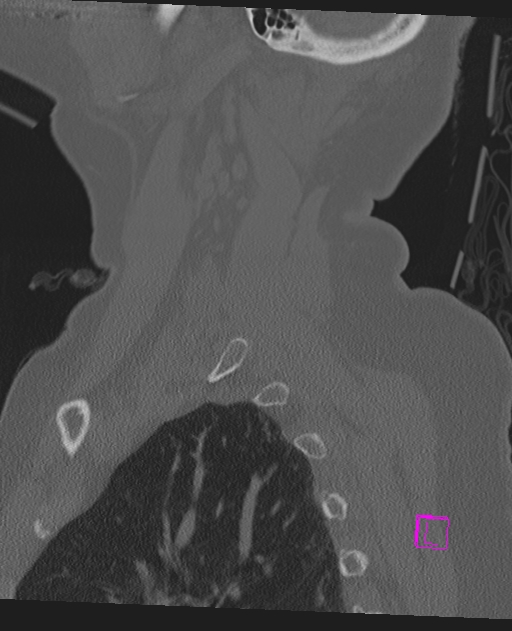 Bilateral atlanto-occipital assimilation (Radiopaedia 28350-28603 Sagittal bone window 67).jpg
