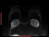 File:Bilateral breast implant rupture (Radiopaedia 24761-25027 DWI 22).jpg