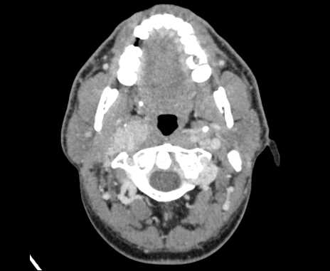 Bilateral carotid body tumors (Radiopaedia 61841-69870 Axial Post contrast 23).jpg